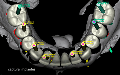 implantes dentales